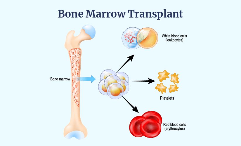 best bone marrow transplant hospitals in delhi